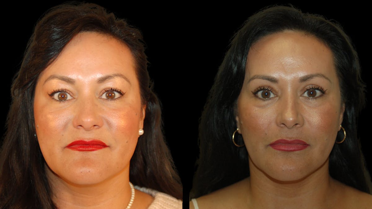 Upper Eyelid Surgery Before & After Gallery - Patient 341385 - Image 1