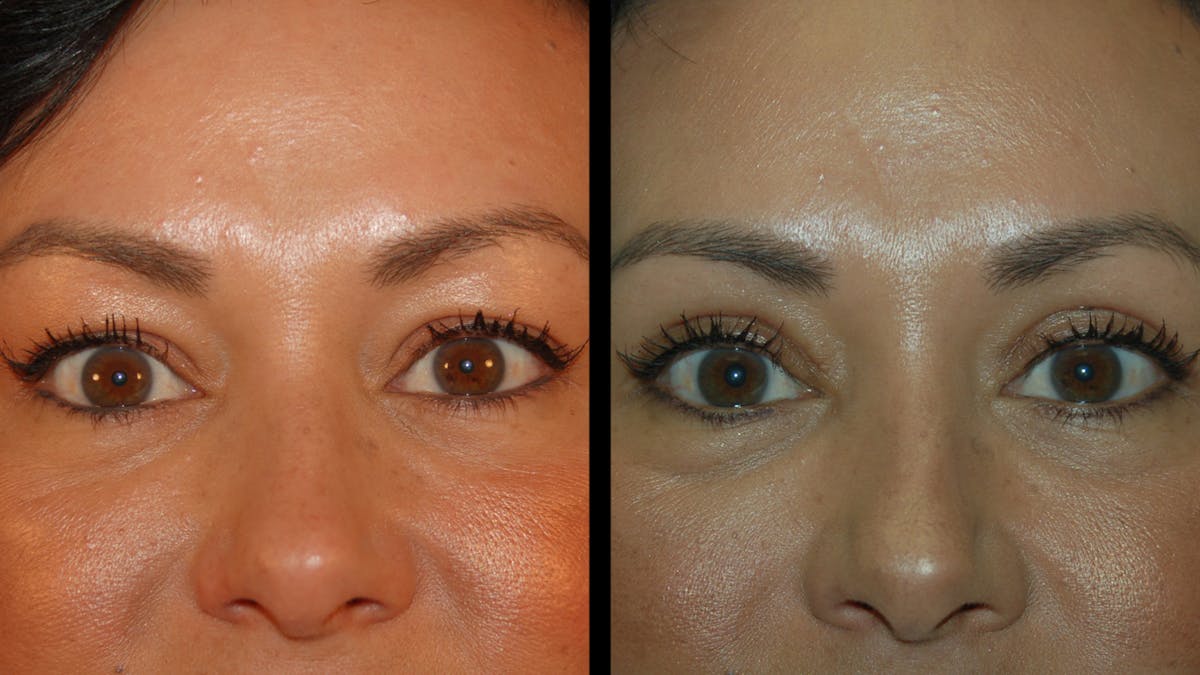 Upper Eyelid Surgery Before & After Gallery - Patient 341385 - Image 2