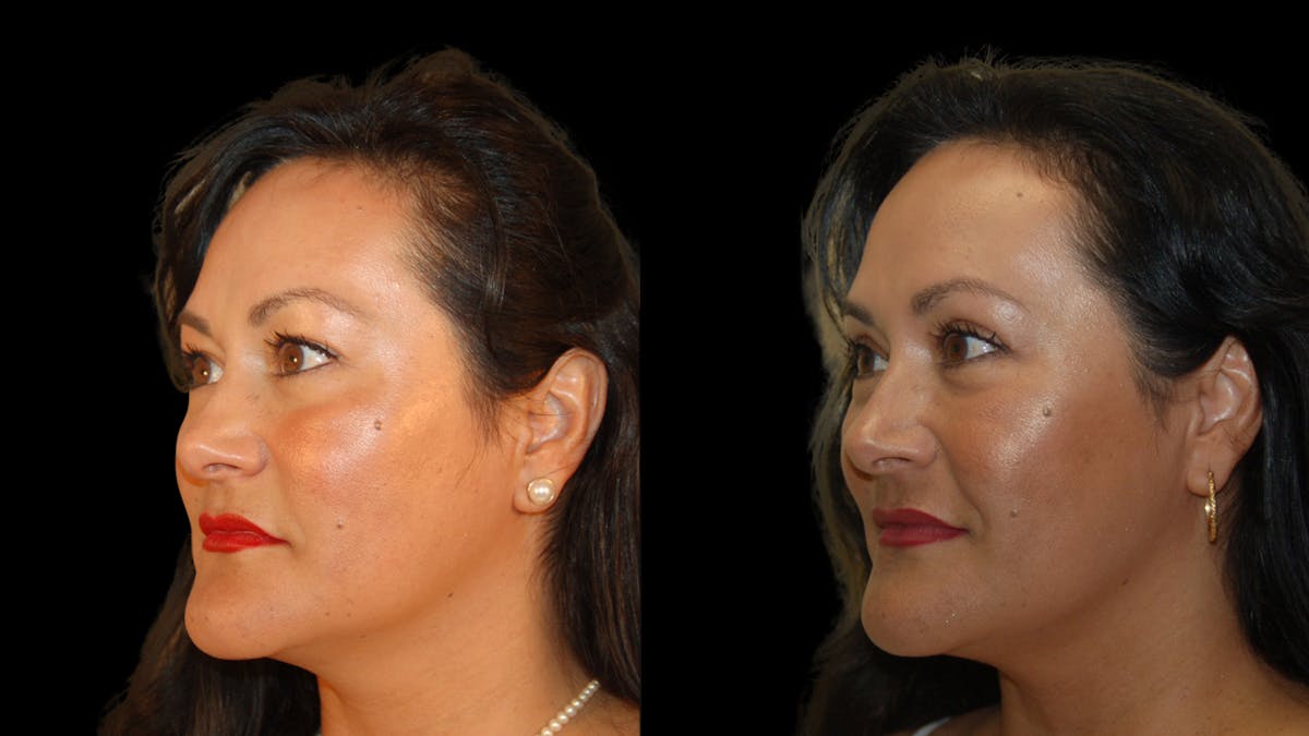 Upper Eyelid Surgery Before & After Gallery - Patient 341385 - Image 3