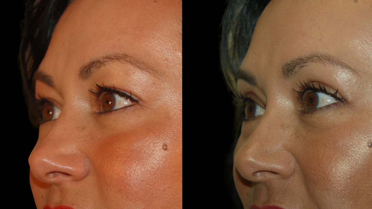 Upper Eyelid Surgery Before & After Gallery - Patient 341385 - Image 4