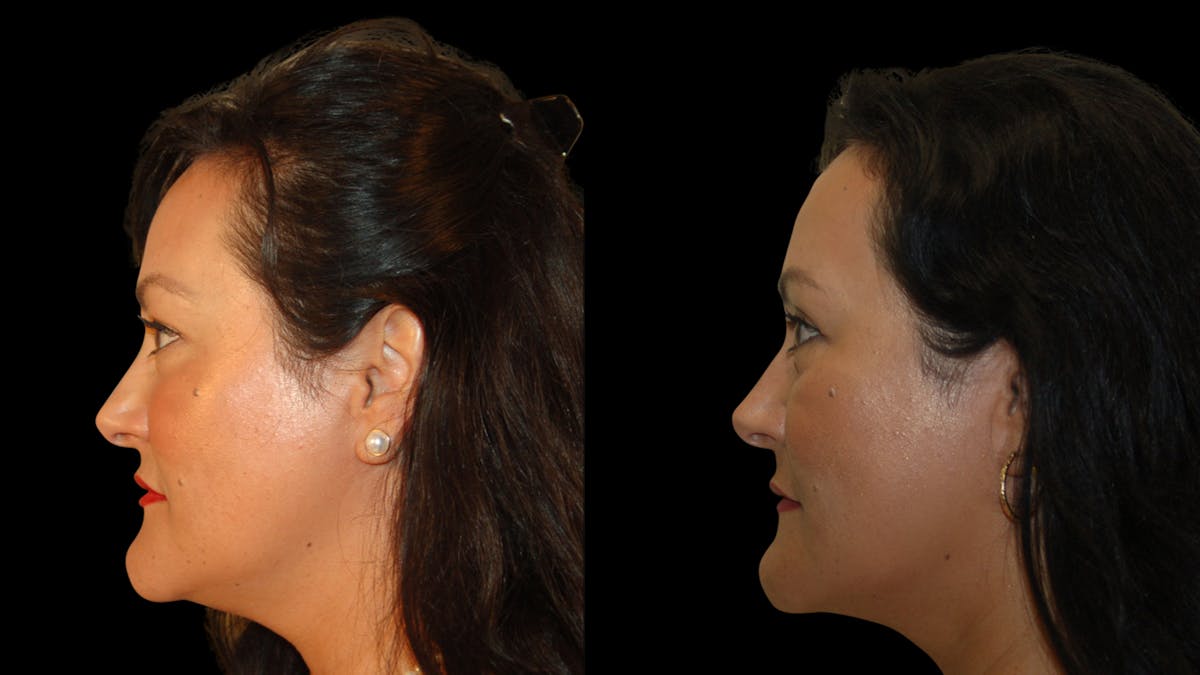 Upper Eyelid Surgery Before & After Gallery - Patient 341385 - Image 5