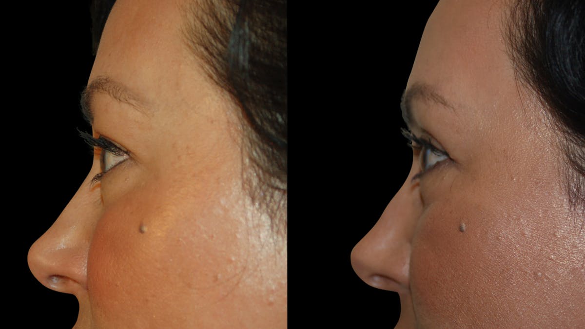 Upper Eyelid Surgery Before & After Gallery - Patient 341385 - Image 6