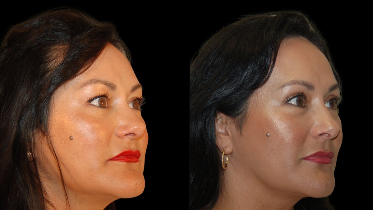 Upper Eyelid Surgery Before & After Gallery - Patient 341385 - Image 7