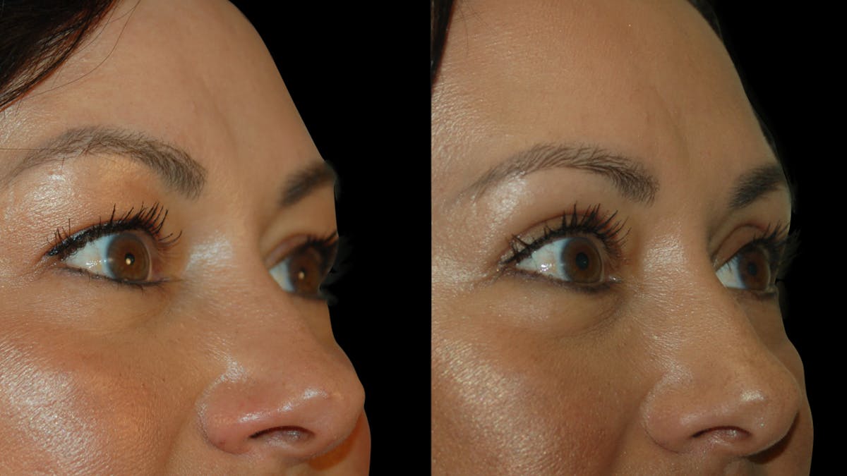 Upper Eyelid Surgery Before & After Gallery - Patient 341385 - Image 8