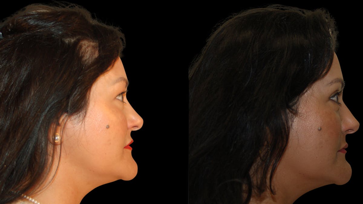 Upper Eyelid Surgery Before & After Gallery - Patient 341385 - Image 9