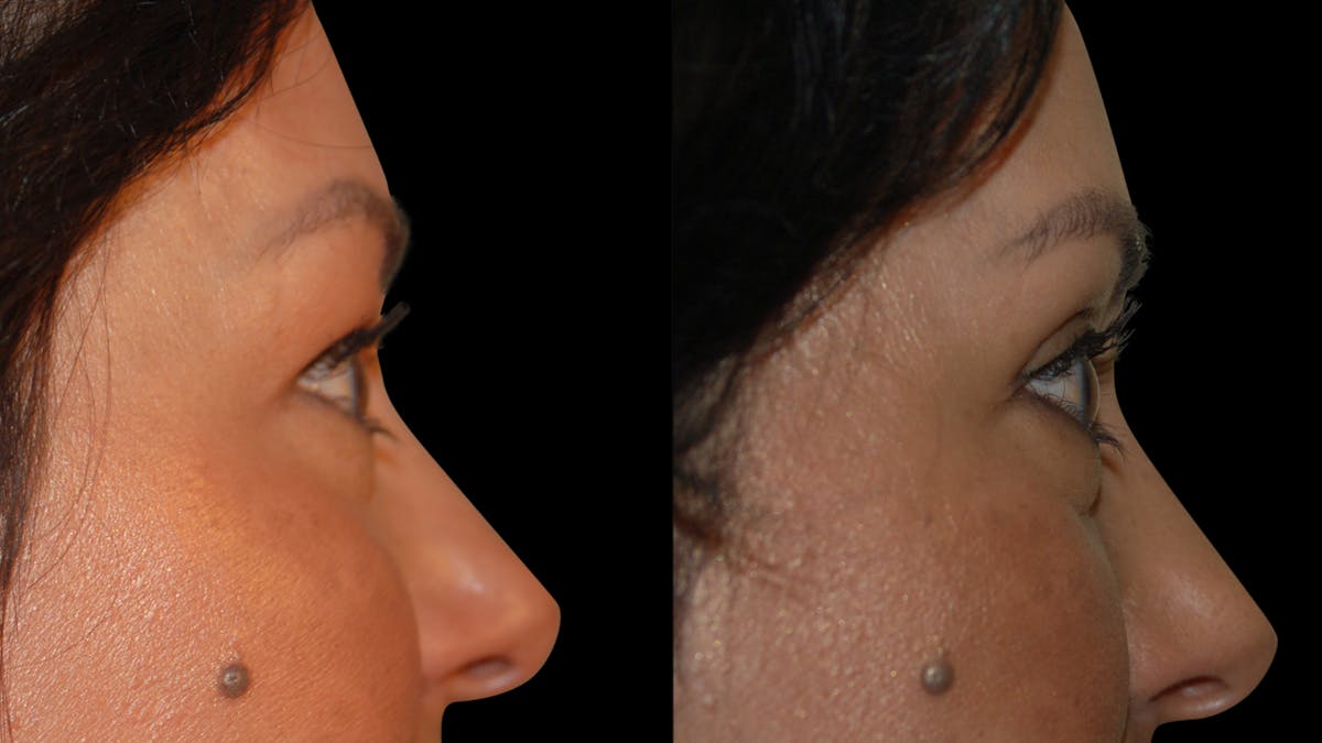 Upper Eyelid Surgery Before & After Gallery - Patient 341385 - Image 10