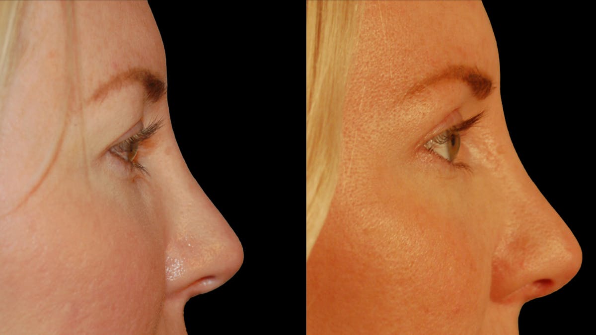 Upper Eyelid Surgery Before & After Gallery - Patient 361648 - Image 2