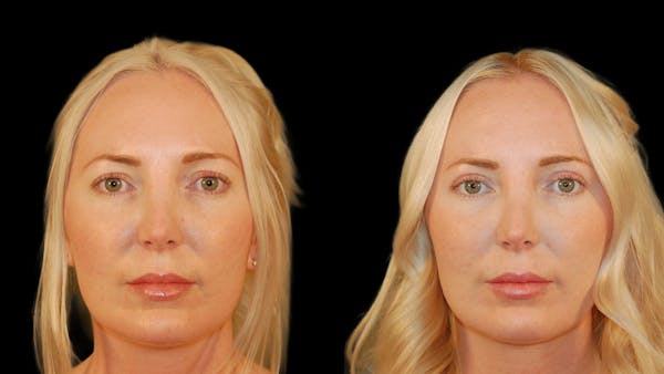 Upper Eyelid Surgery Before & After Gallery - Patient 361648 - Image 1