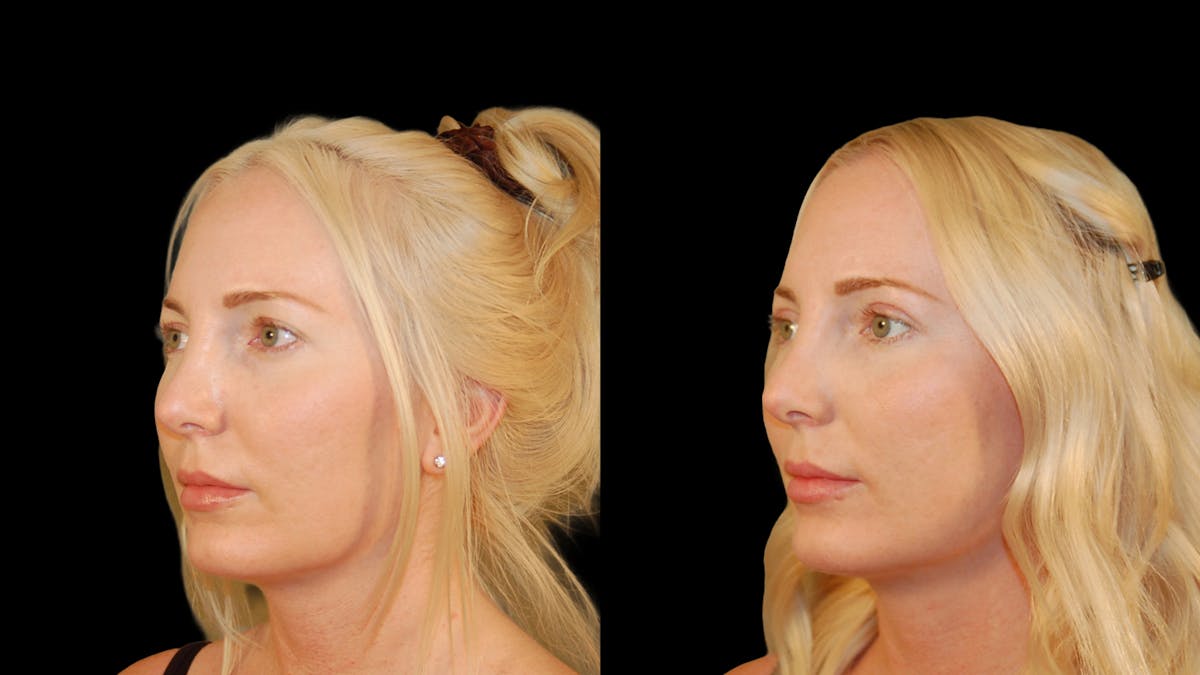 Upper Eyelid Surgery Before & After Gallery - Patient 361648 - Image 3