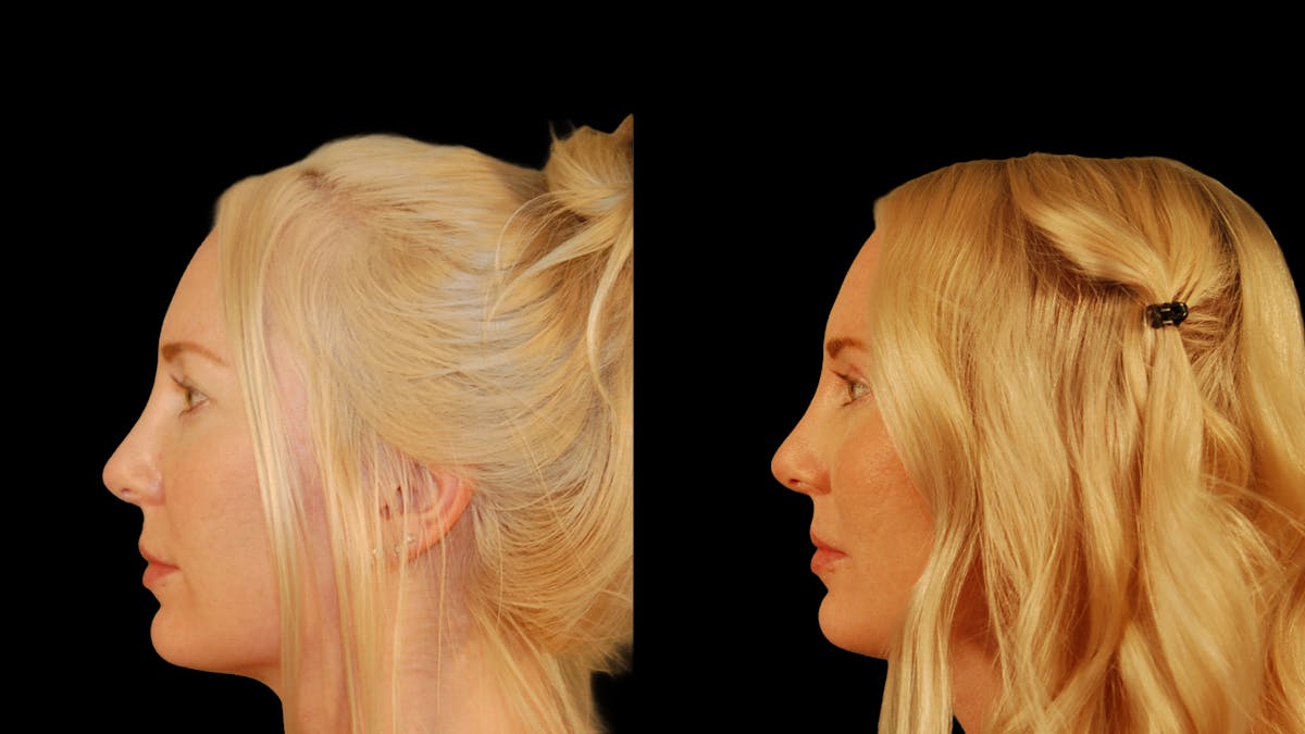 Upper Eyelid Surgery Before & After Gallery - Patient 361648 - Image 4
