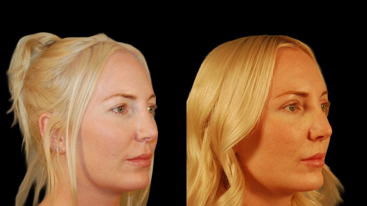 Upper Eyelid Surgery Before & After Gallery - Patient 361648 - Image 5