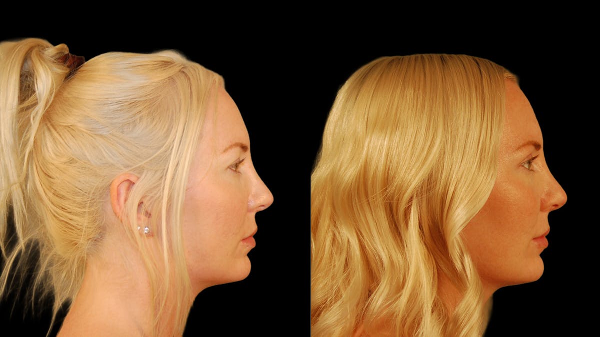 Upper Eyelid Surgery Before & After Gallery - Patient 361648 - Image 6