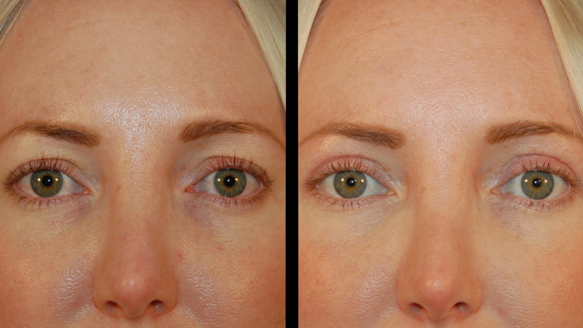 Upper Eyelid Surgery Before & After Gallery - Patient 361648 - Image 7