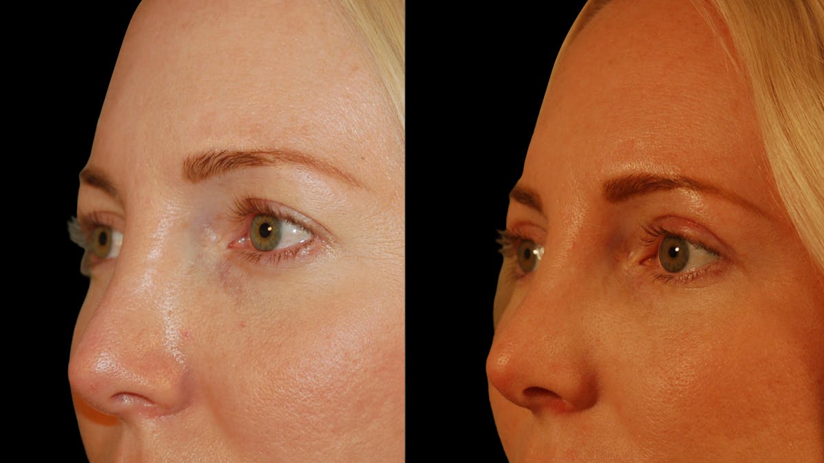 Upper Eyelid Surgery Before & After Gallery - Patient 361648 - Image 8