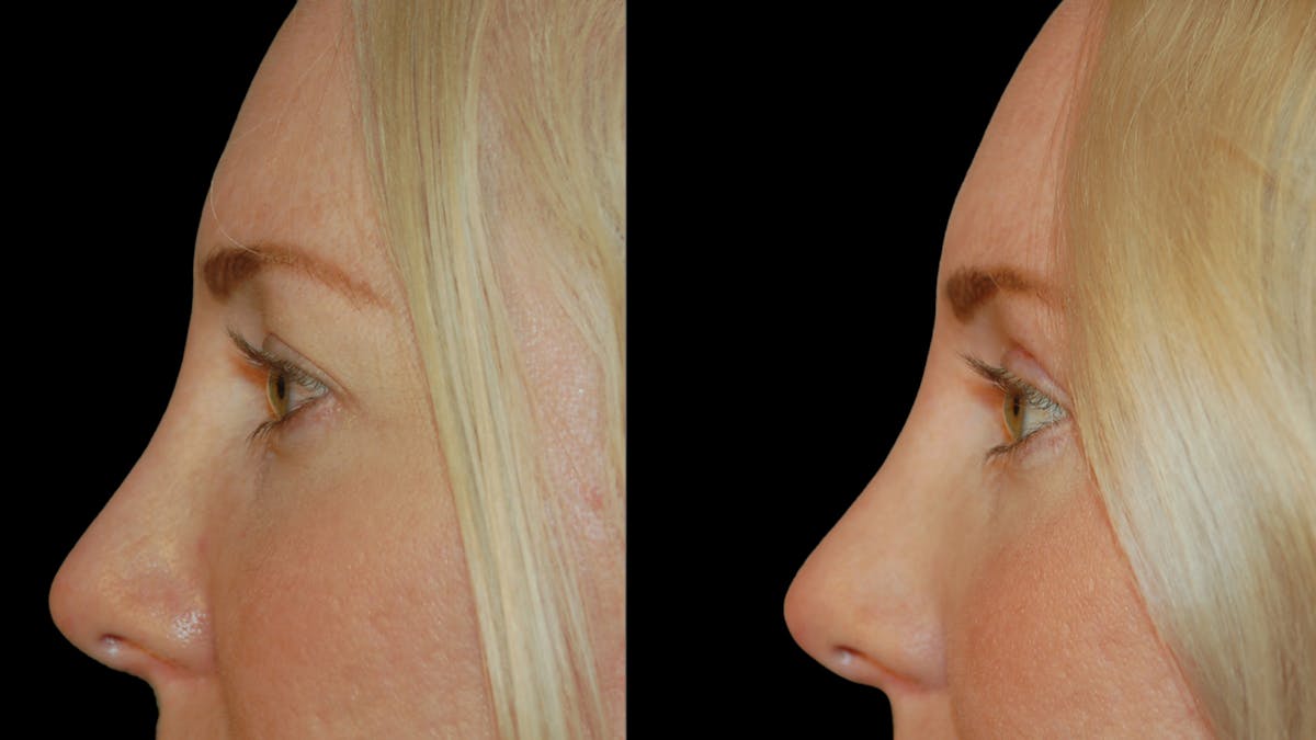Upper Eyelid Surgery Before & After Gallery - Patient 361648 - Image 9