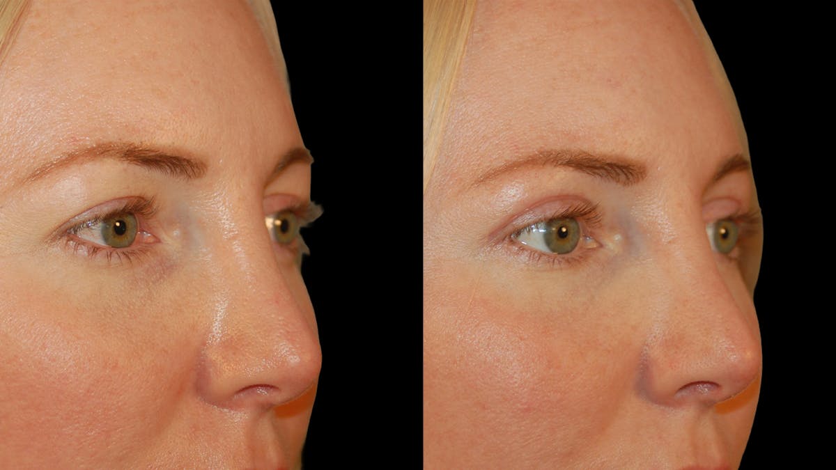 Upper Eyelid Surgery Before & After Gallery - Patient 361648 - Image 10