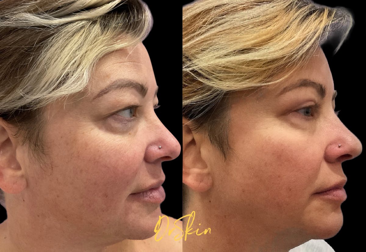 Upper Eyelid Surgery Before & After Gallery - Patient 396227 - Image 2