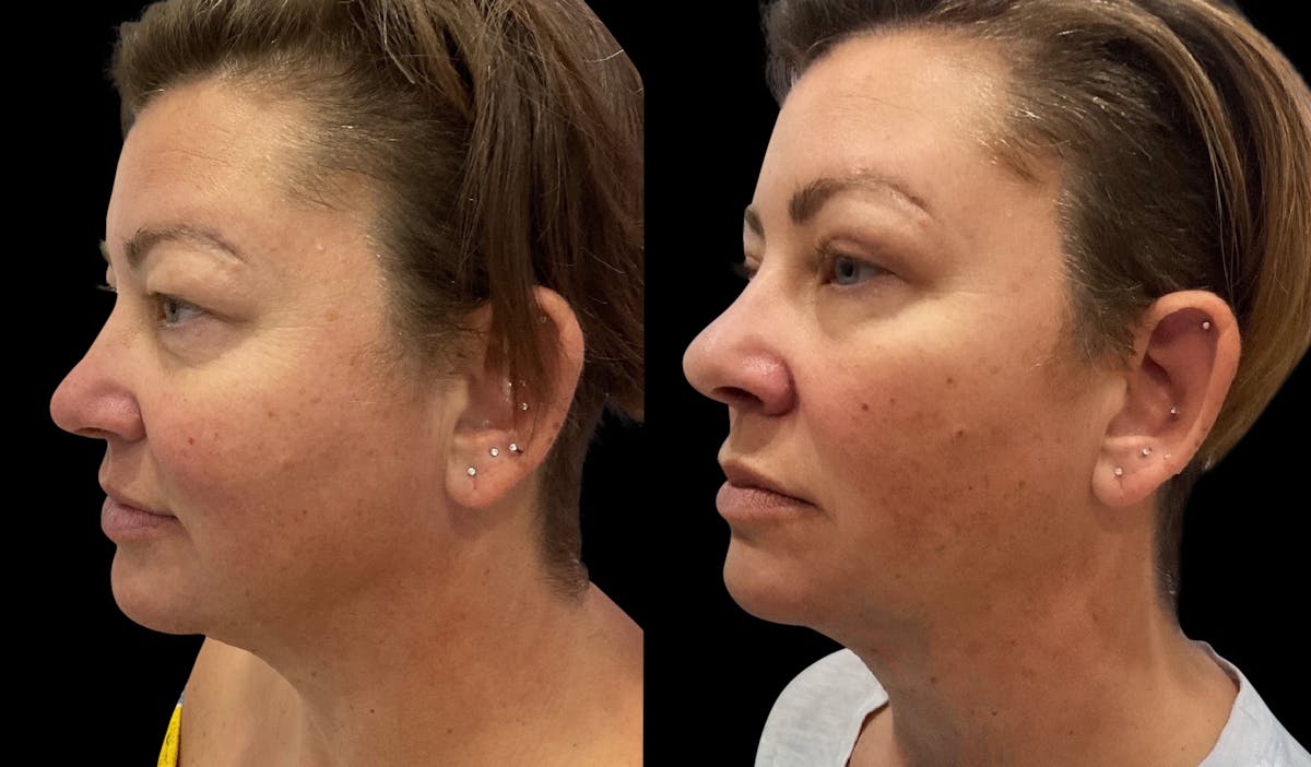 Upper Eyelid Surgery Before & After Gallery - Patient 396227 - Image 3