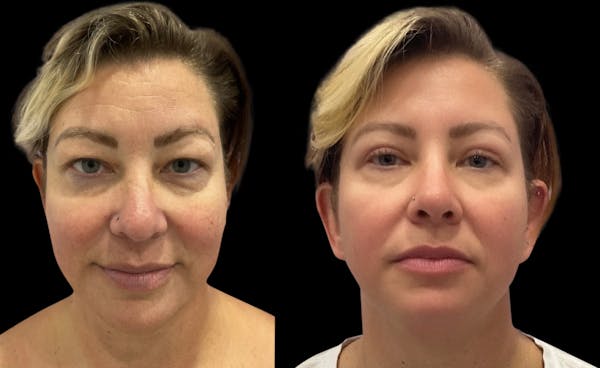 Upper Eyelid Surgery Before & After Gallery - Patient 396227 - Image 1