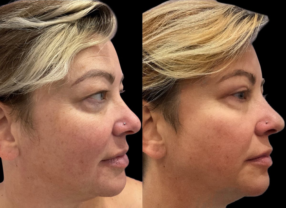 Upper Eyelid Surgery Before & After Gallery - Patient 396227 - Image 4