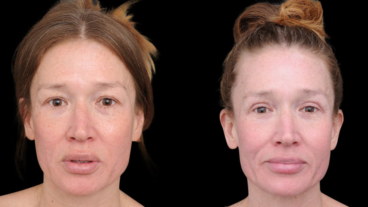 Upper Eyelid Surgery Before & After Gallery - Patient 674966 - Image 1
