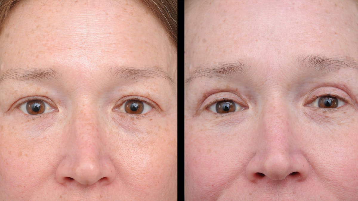 Upper Eyelid Surgery Before & After Gallery - Patient 674966 - Image 2