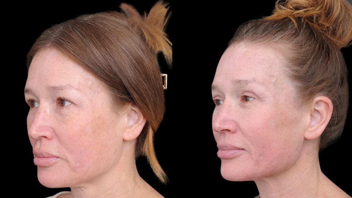 Upper Eyelid Surgery Before & After Gallery - Patient 674966 - Image 3