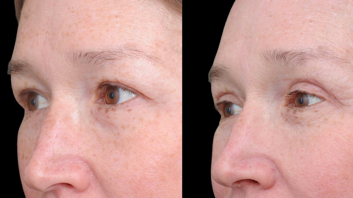 Upper Eyelid Surgery Before & After Gallery - Patient 674966 - Image 4