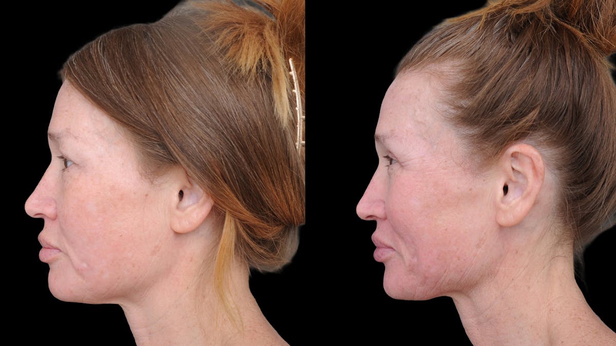 Upper Eyelid Surgery Before & After Gallery - Patient 674966 - Image 5