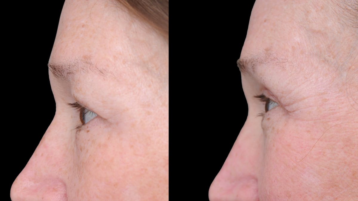 Upper Eyelid Surgery Before & After Gallery - Patient 674966 - Image 6