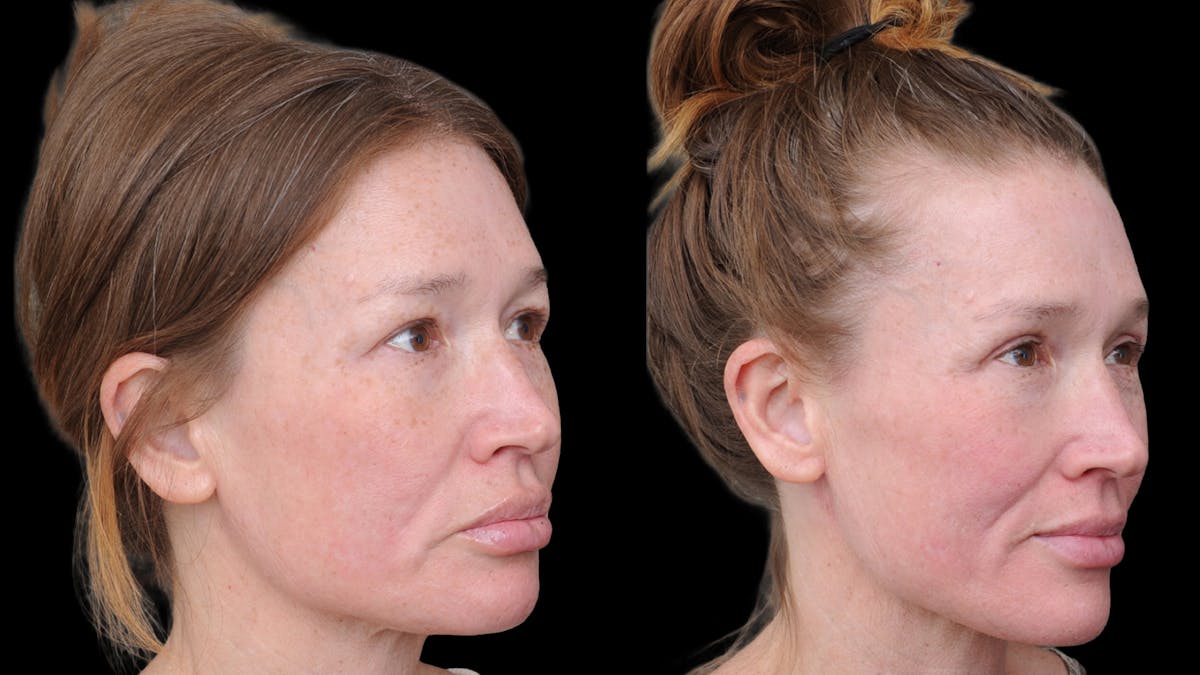 Upper Eyelid Surgery Before & After Gallery - Patient 674966 - Image 7