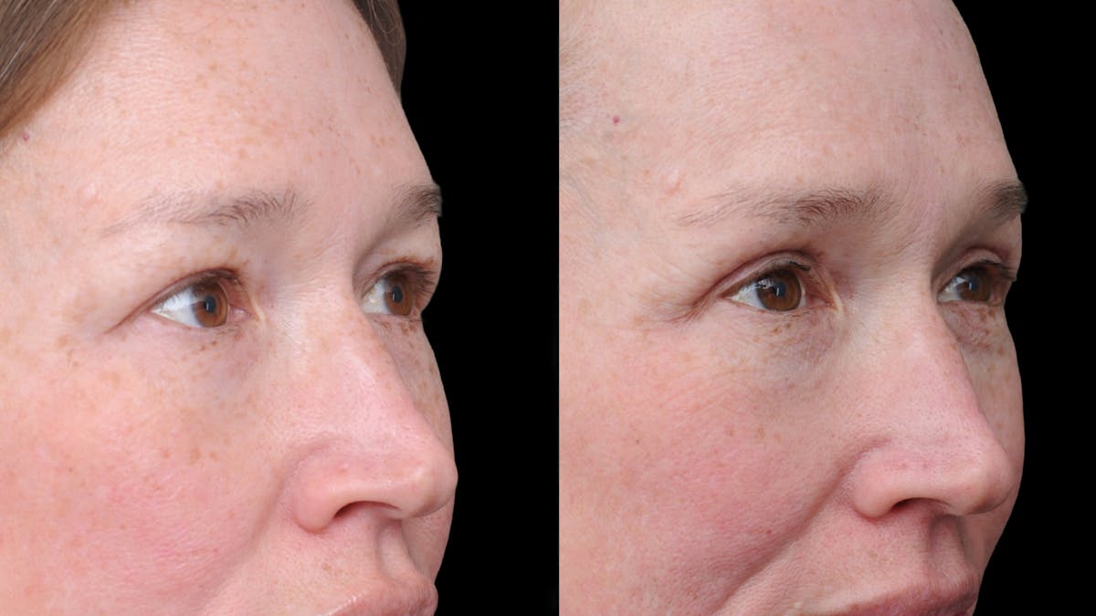 Upper Eyelid Surgery Before & After Gallery - Patient 674966 - Image 8