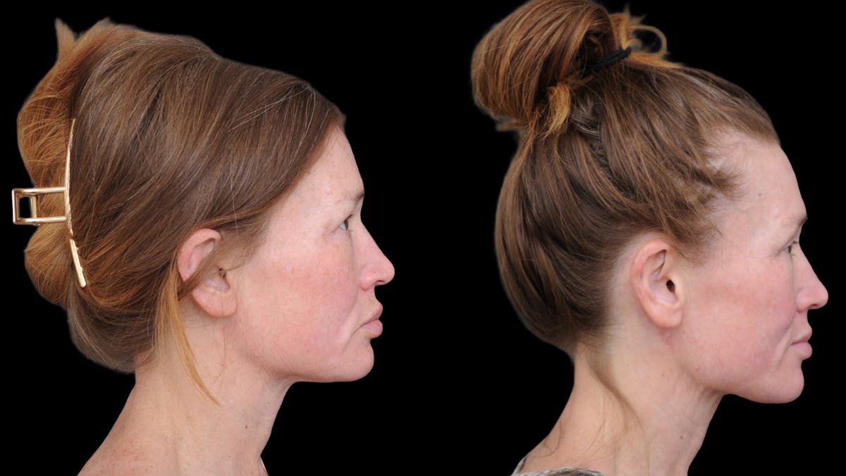 Upper Eyelid Surgery Before & After Gallery - Patient 674966 - Image 9