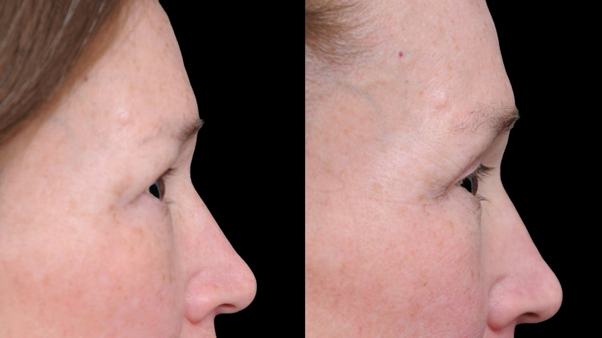 Upper Eyelid Surgery Before & After Gallery - Patient 674966 - Image 10