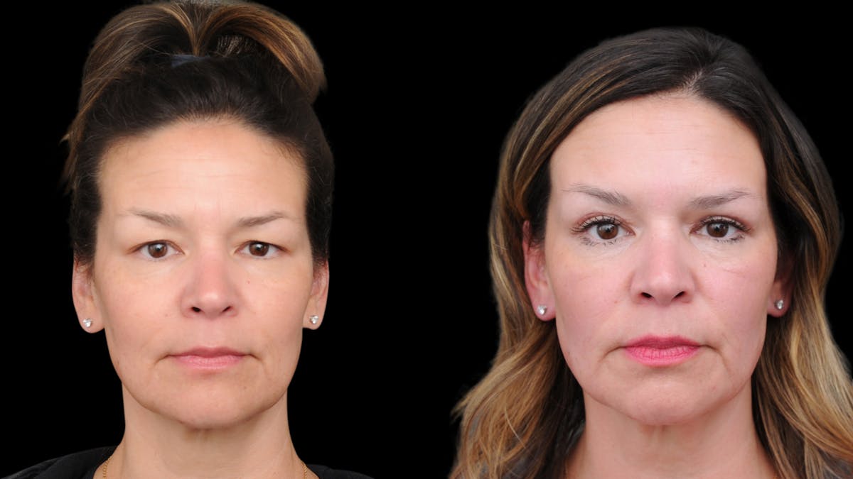 Upper Eyelid Surgery Before & After Gallery - Patient 189245 - Image 1