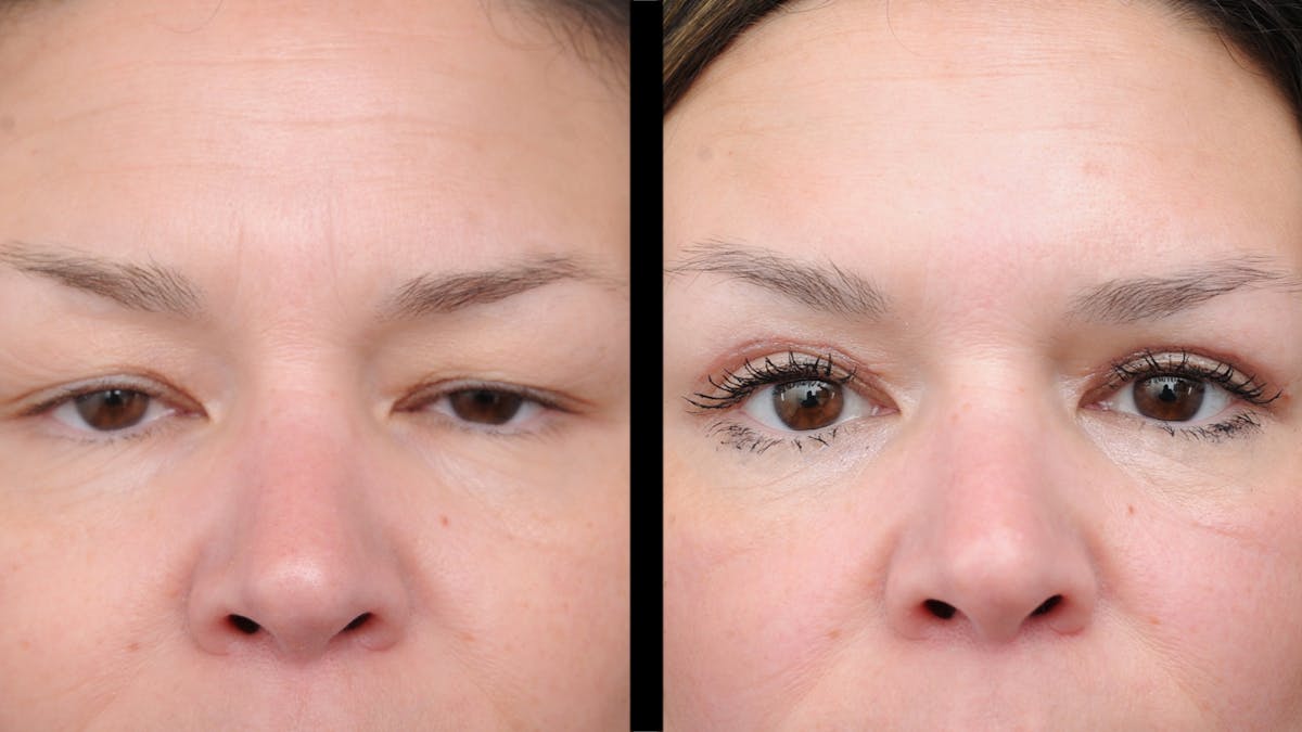 Upper Eyelid Surgery Before & After Gallery - Patient 189245 - Image 2