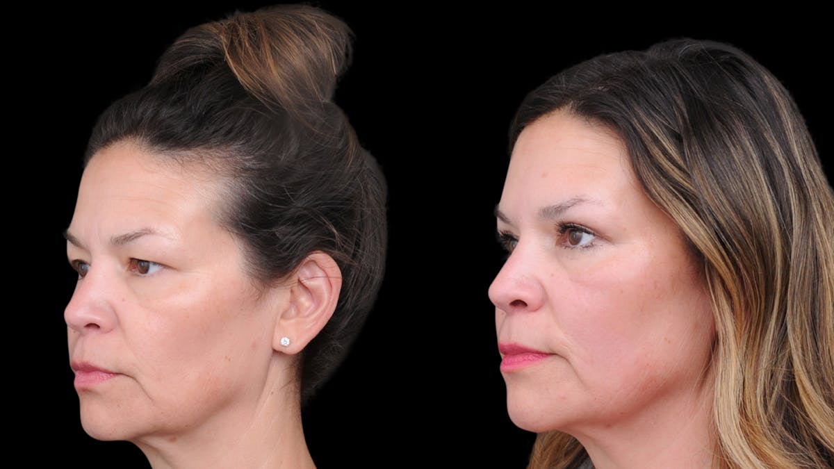 Upper Eyelid Surgery Before & After Gallery - Patient 189245 - Image 3