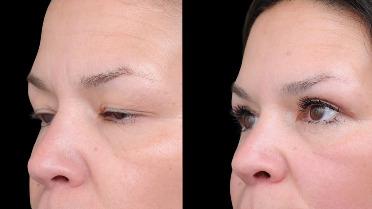 Upper Eyelid Surgery Before & After Gallery - Patient 189245 - Image 4