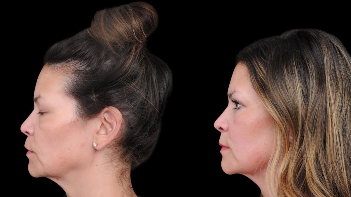 Upper Eyelid Surgery Before & After Gallery - Patient 189245 - Image 5