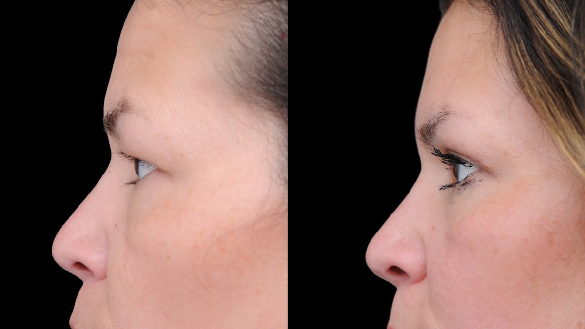 Upper Eyelid Surgery Before & After Gallery - Patient 189245 - Image 6