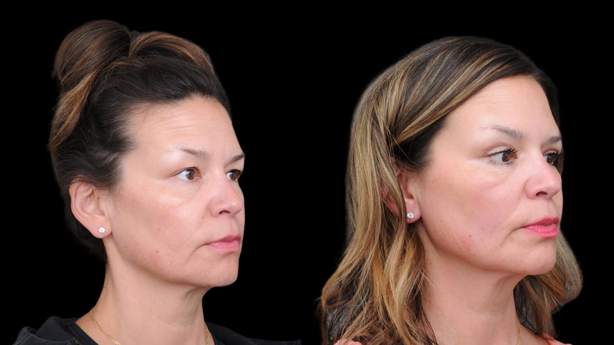 Upper Eyelid Surgery Before & After Gallery - Patient 189245 - Image 7