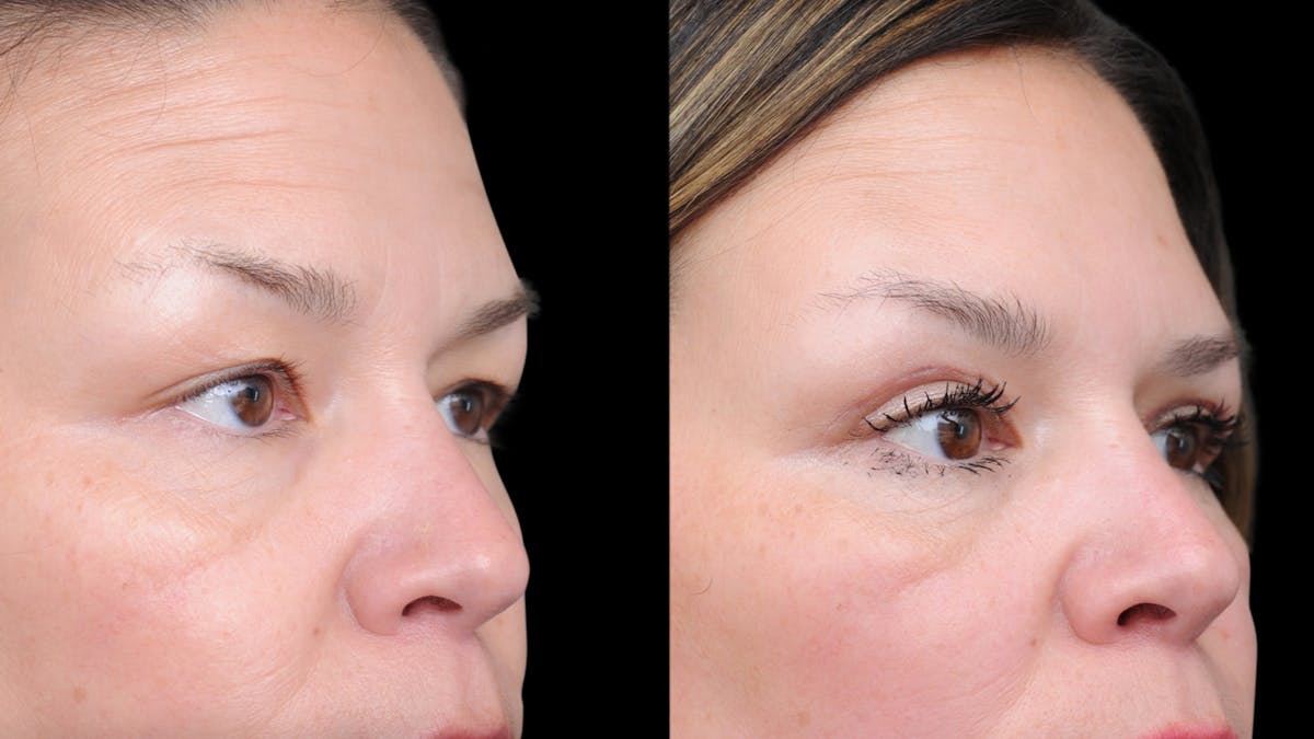 Upper Eyelid Surgery Before & After Gallery - Patient 189245 - Image 8