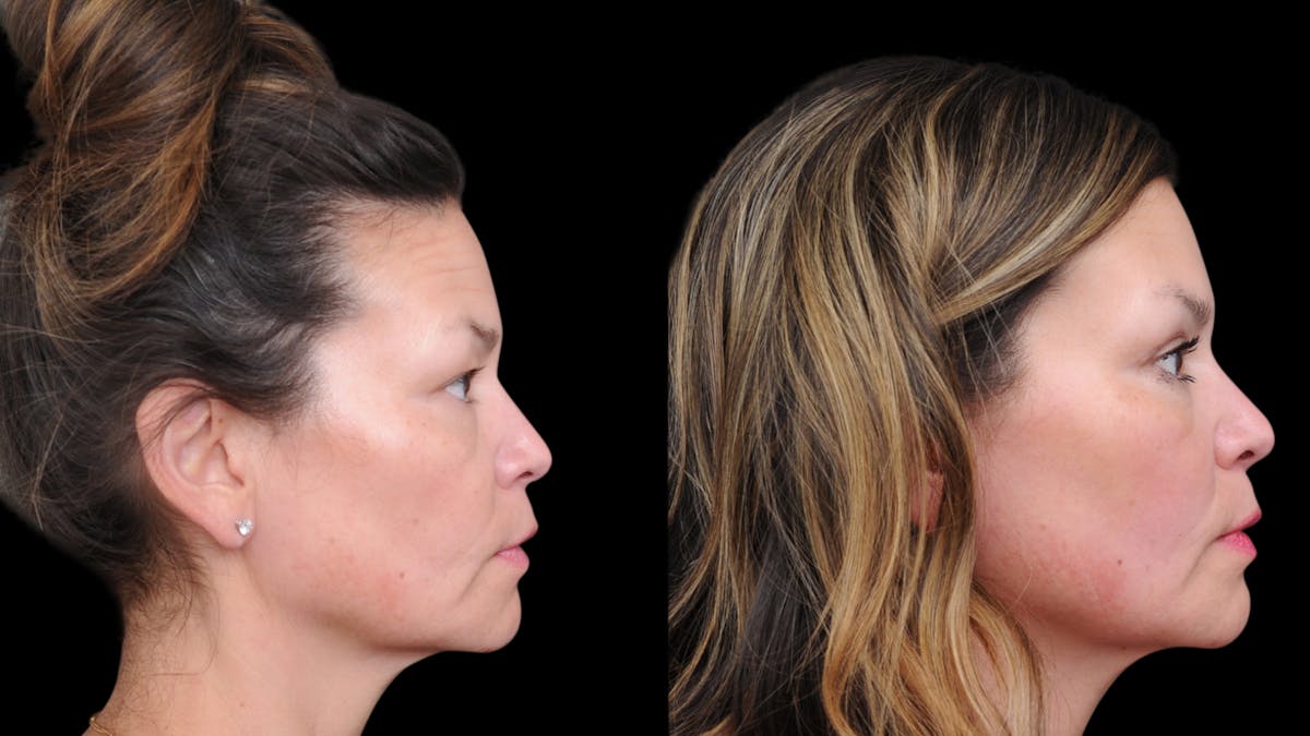 Upper Eyelid Surgery Before & After Gallery - Patient 189245 - Image 9