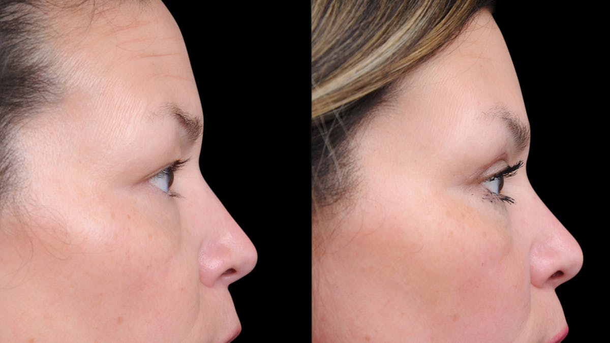 Upper Eyelid Surgery Before & After Gallery - Patient 189245 - Image 10