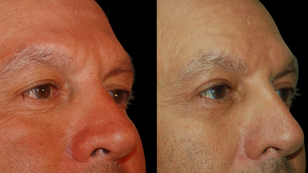 Upper Eyelid Surgery Before & After Gallery - Patient 377228 - Image 2