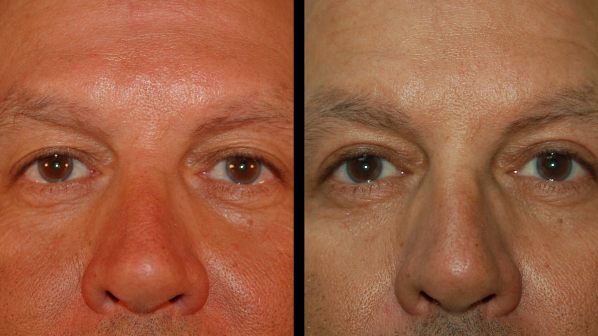 Upper Eyelid Surgery Before & After Gallery - Patient 377228 - Image 1