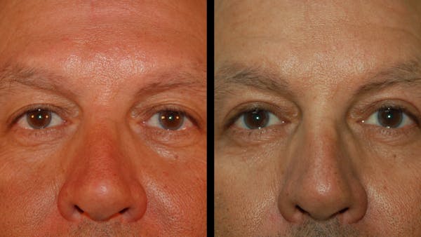 Upper Eyelid Surgery Before & After Gallery - Patient 377228 - Image 1