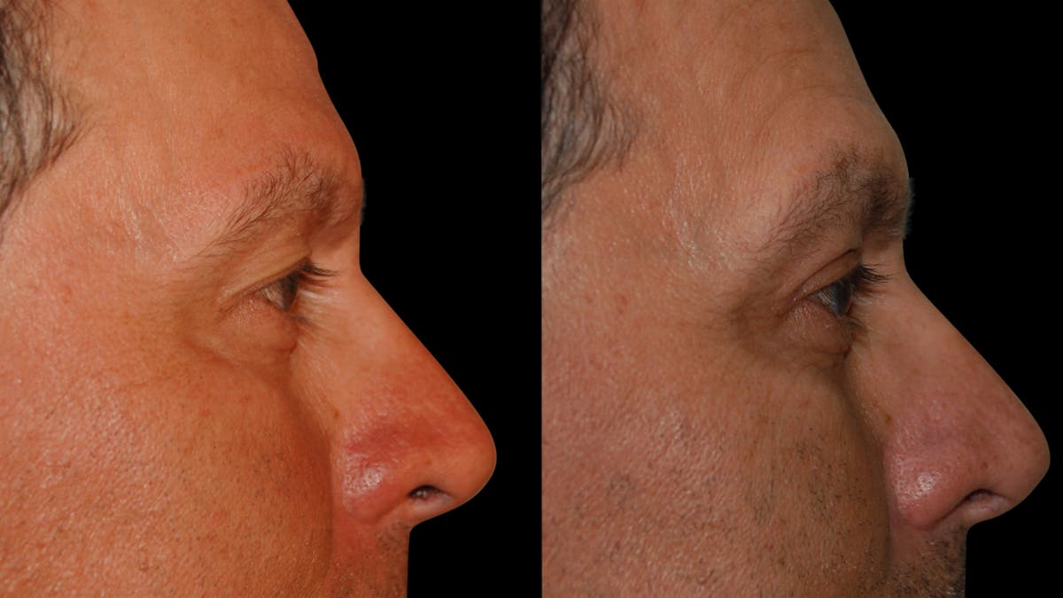 Upper Eyelid Surgery Before & After Gallery - Patient 377228 - Image 3