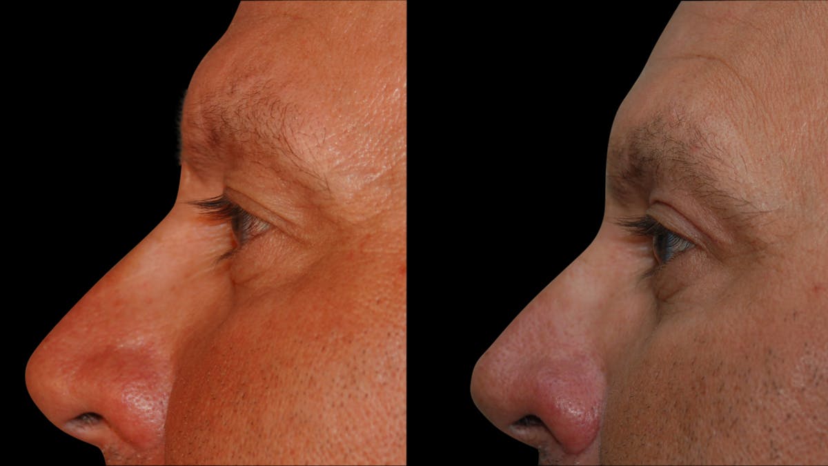 Upper Eyelid Surgery Before & After Gallery - Patient 377228 - Image 4