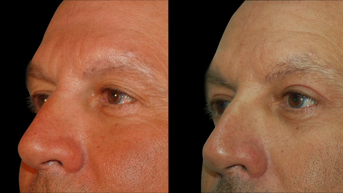 Upper Eyelid Surgery Before & After Gallery - Patient 377228 - Image 5